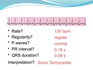 130 bpm
• Rate?
• Regularity? regular
normal
0.08 s
• P waves?
• PR interval? 0.16 s
• QRS duration?
Interpretation? Sinus Tachycardia
 