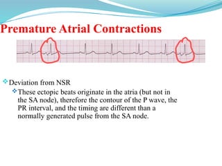 Premature Atrial Contractions
Deviation from NSR
These ectopic beats originate in the atria (but not in
the SA node), therefore the contour of the P wave, the
PR interval, and the timing are different than a
normally generated pulse from the SA node.
 