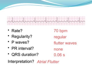 70 bpm
• Rate?
• Regularity? regular
flutter waves
0.06 s
• P waves?
• PR interval? none
• QRS duration?
Interpretation? Atrial Flutter
 