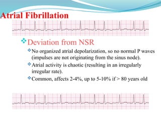 Atrial Fibrillation
Deviation from NSR
No organized atrial depolarization, so no normal P waves
(impulses are not originating from the sinus node).
Atrial activity is chaotic (resulting in an irregularly
irregular rate).
Common, affects 2-4%, up to 5-10% if > 80 years old
 