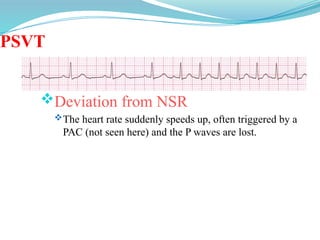 PSVT
Deviation from NSR
The heart rate suddenly speeds up, often triggered by a
PAC (not seen here) and the P waves are lost.
 