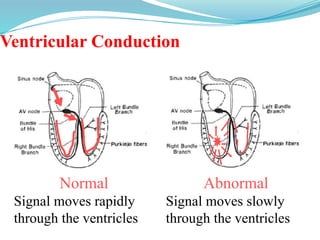 Ventricular Conduction
Normal
Signal moves rapidly
through the ventricles
Abnormal
Signal moves slowly
through the ventricles
 