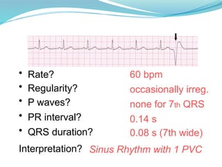 60 bpm
• Rate?
• Regularity? occasionally irreg.
none for 7th QRS
0.08 s (7th wide)
• P waves?
• PR interval? 0.14 s
• QRS duration?
Interpretation? Sinus Rhythm with 1 PVC
 
