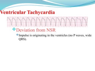 Ventricular Tachycardia
Deviation from NSR
Impulse is originating in the ventricles (no P waves, wide
QRS).
 