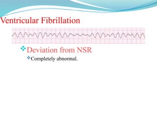 Ventricular Fibrillation
Deviation from NSR
Completely abnormal.
 