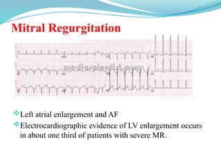 Mitral Regurgitation
Left atrial enlargement and AF
Electrocardiographic evidence of LV enlargement occurs
in about one third of patients with severe MR.
 