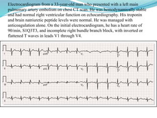 Electrocardiogram from a 33-year-old man who presented with a left main
pulmonary artery embolism on chest CT scan. He was hemodynamically stable
and had normal right ventricular function on echocardiography. His troponin
and brain natriuretic peptide levels were normal. He was managed with
anticoagulation alone. On the initial electrocardiogram, he has a heart rate of
90/min, S1Q3T3, and incomplete right bundle branch block, with inverted or
flattened T waves in leads V1 through V4.
 