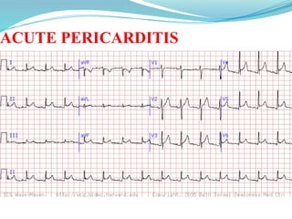 ACUTE PERICARDITIS
 