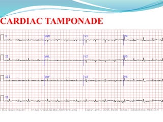 CARDIAC TAMPONADE
 