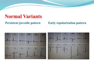 Normal Variants
Persistent juvenile pattern Early repolarization pattern
 