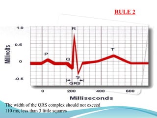 RULE 2
The width of the QRS complex should not exceed
110 ms, less than 3 little squares
 