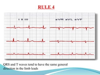 RULE 4
QRS and T waves tend to have the same general
direction in the limb leads
 