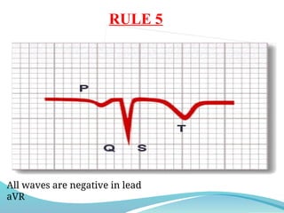 RULE 5
All waves are negative in lead
aVR
 