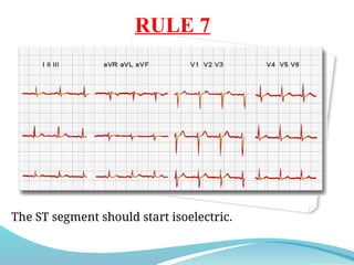 RULE 7
The ST segment should start isoelectric.
 