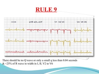 RULE 9
There should be no Q wave or only a small q less than 0.04 seconds
& <25% of R wave in width in I, II, V2 to V6
 