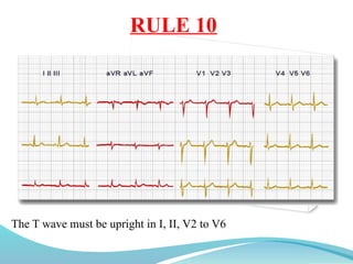 RULE 10
The T wave must be upright in I, II, V2 to V6
 