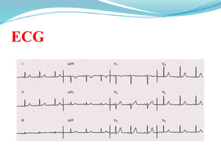 ECG
 