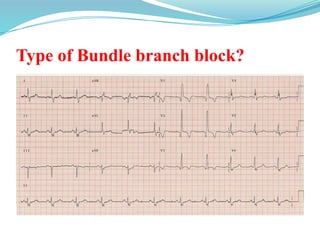 Type of Bundle branch block?
 