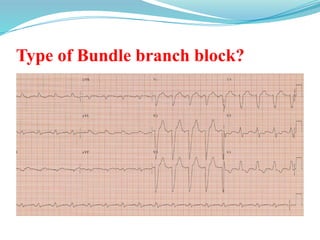 Type of Bundle branch block?
 