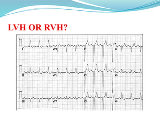 LVH OR RVH?
 