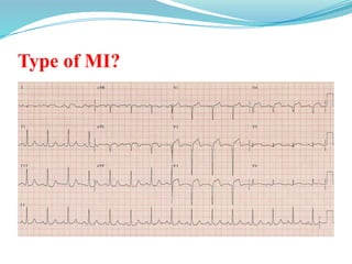 Type of MI?
 
