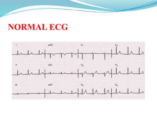 NORMAL ECG
 