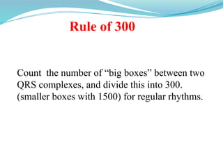 Rule of 300
Count the number of “big boxes” between two
QRS complexes, and divide this into 300.
(smaller boxes with 1500) for regular rhythms.
 