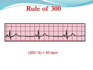 Rule of 300
(300 / 6) = 50 bpm
 