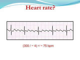 Heart rate?
(300 / ~ 4) = ~ 75 bpm
 
