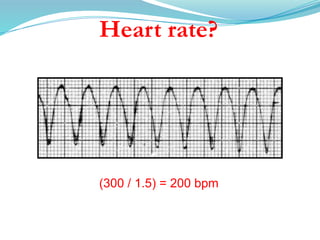 Heart rate?
(300 / 1.5) = 200 bpm
 