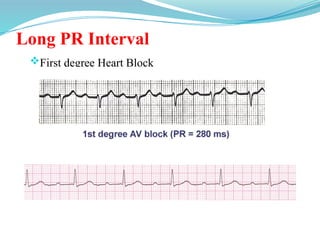 Long PR Interval
First degree Heart Block
 