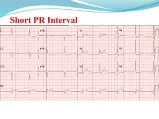 Short PR Interval
 WPW (Wolff-
Parkinson-White)
Syndrome
 Accessory pathway
(Bundle of Kent)
allows early activation
of the ventricle (delta
wave and short PR
interval)
 