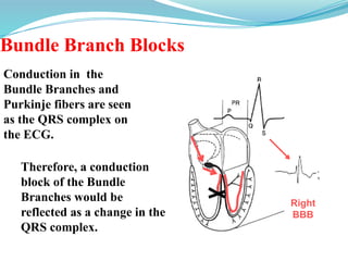 Bundle Branch Blocks
Conduction in the
Bundle Branches and
Purkinje fibers are seen
as the QRS complex on
the ECG.
Therefore, a conduction
block of the Bundle
Branches would be
reflected as a change in the
QRS complex.
Right
BBB
 