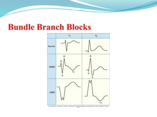 Bundle Branch Blocks
 