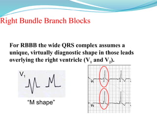 Right Bundle Branch Blocks
V1
For RBBB the wide QRS complex assumes a
unique, virtually diagnostic shape in those leads
overlying the right ventricle (V1 and V2).
“M shape”
 