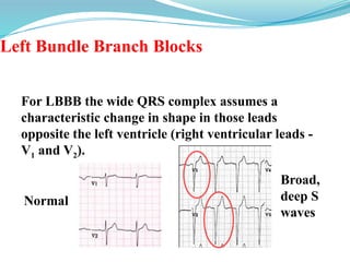 Left Bundle Branch Blocks
For LBBB the wide QRS complex assumes a
characteristic change in shape in those leads
opposite the left ventricle (right ventricular leads -
V1 and V2).
Broad,
deep S
waves
Normal
 