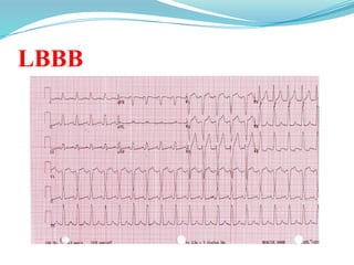 LBBB
 