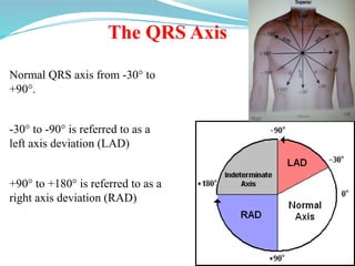 The QRS Axis
Normal QRS axis from -30° to
+90°.
-30° to -90° is referred to as a
left axis deviation (LAD)
+90° to +180° is referred to as a
right axis deviation (RAD)
 