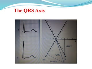 The QRS Axis
 