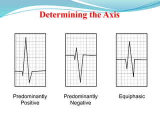 Determining the Axis
Predominantly
Positive
Predominantly
Negative
Equiphasic
 