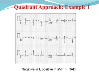 Quadrant Approach: Example 1
Negative in I, positive in aVF  RAD
 