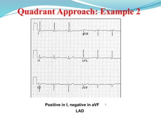 Quadrant Approach: Example 2
Positive in I, negative in aVF 
LAD
 