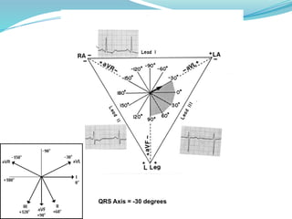 QRS Axis = -30 degrees
 