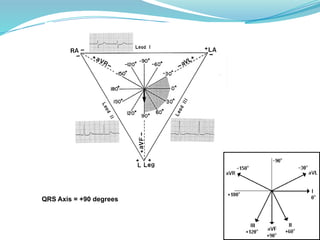 QRS Axis = +90 degrees
 
