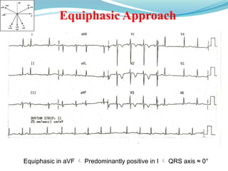 Equiphasic Approach
Equiphasic in aVF  Predominantly positive in I  QRS axis ≈ 0°
 
