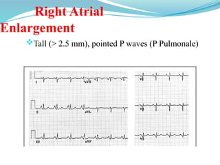 Right Atrial
Enlargement
Tall (> 2.5 mm), pointed P waves (P Pulmonale)
 