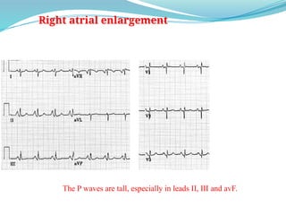 Right atrial enlargement
The P waves are tall, especially in leads II, III and avF.
 