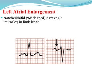  Notched/bifid (‘M’ shaped) P wave (P
‘mitrale’) in limb leads
Left Atrial Enlargement
 