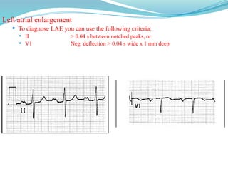 Left atrial enlargement
 To diagnose LAE you can use the following criteria:
 II > 0.04 s between notched peaks, or
 V1 Neg. deflection > 0.04 s wide x 1 mm deep
Normal LAE
 