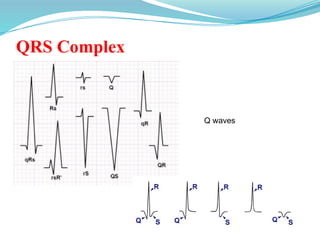 QRS Complex
Q waves
 